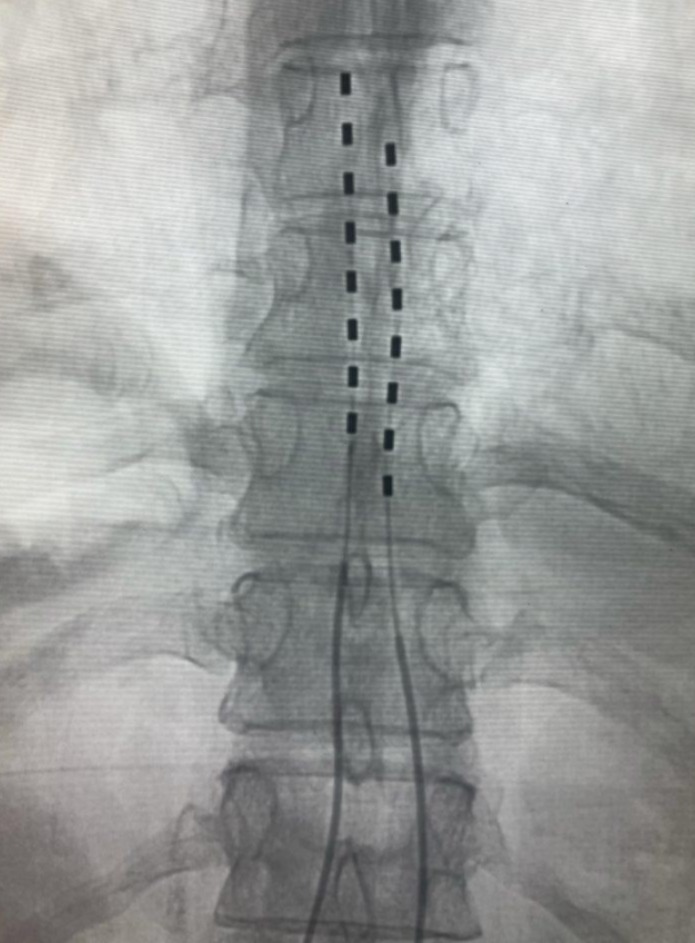 Estimulação Medular