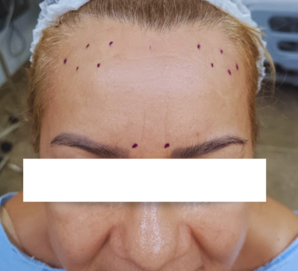 Toxina Botulínica